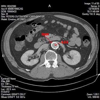 Royalty-free aneurysm photos free download | Pxfuel