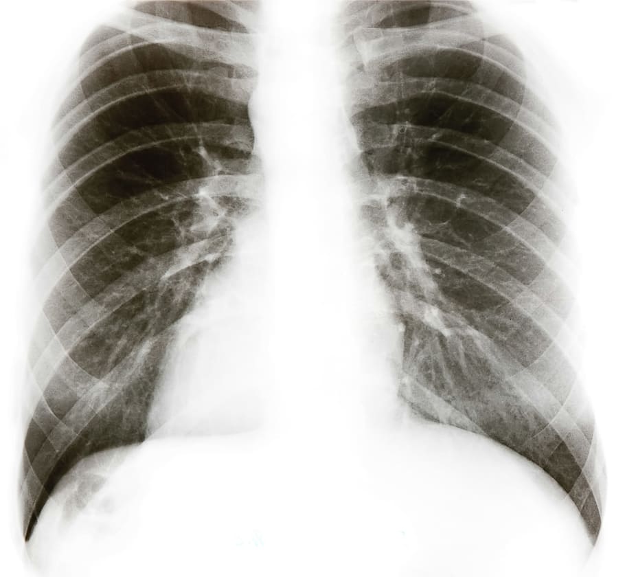 x, ray, chest, xray, health, care, medical, x-ray, background, white | Pxfuel