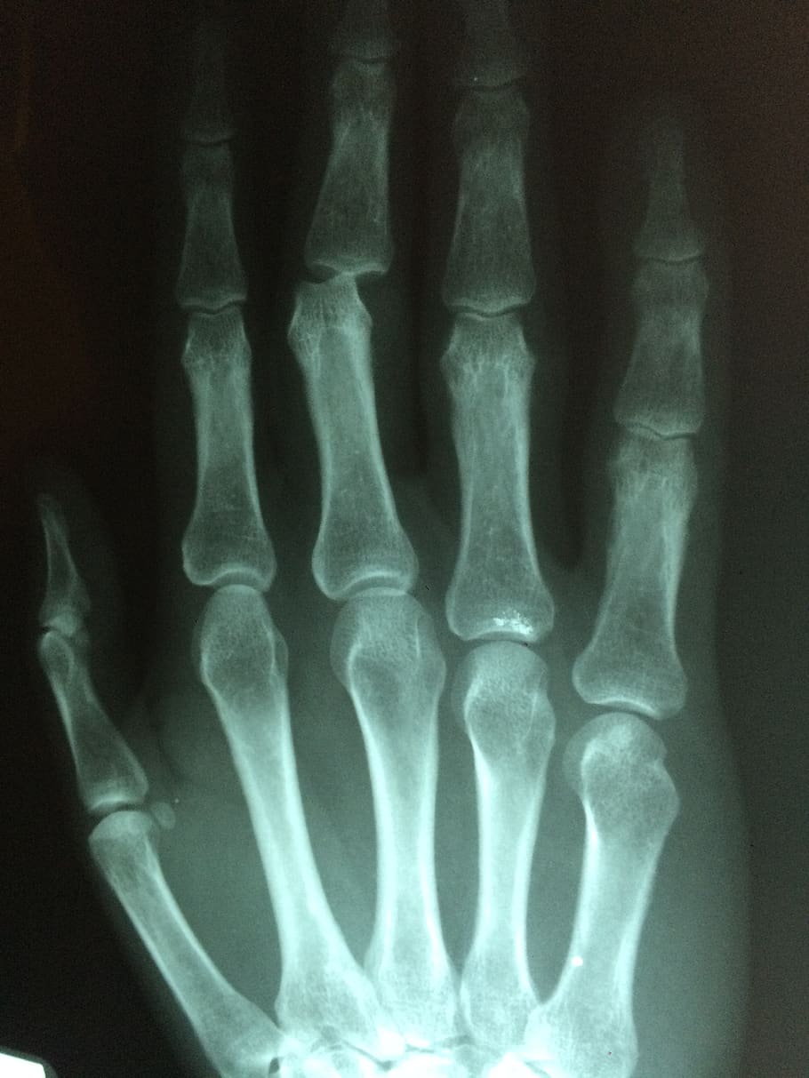 hand, fracture, broken, injury, pain, patient, medicine, hospital, doctor, healthcare