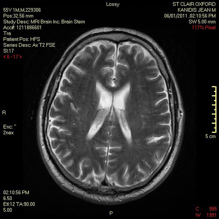 brain, scan, mri, demyelinating, medical, doctors, magnetic, resonance, imaging, healthcare and medicine